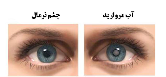 كاتاراكت(آب مروارید)