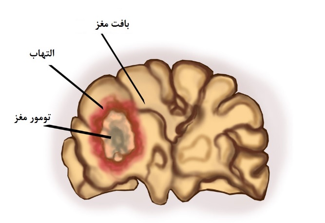 تومورمغزی