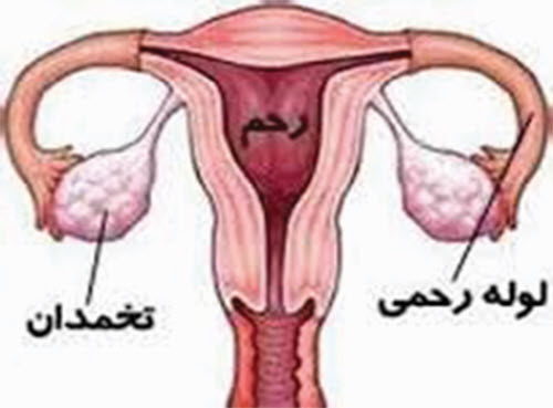 هیستركتومی ابدومینال