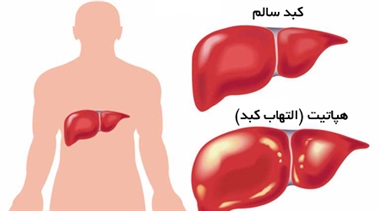 هپاتیت