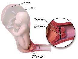 خود مراقبتی بعداز سركلاژ