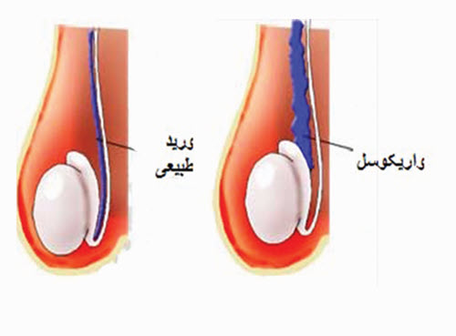 واریكوسل